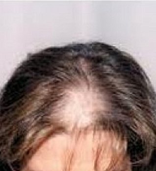 Read online Hair Loss: Hair Loss for Women: Hair Loss Cures: Hair Loss Boos: Everything you need to know - Dale Waller | PDF